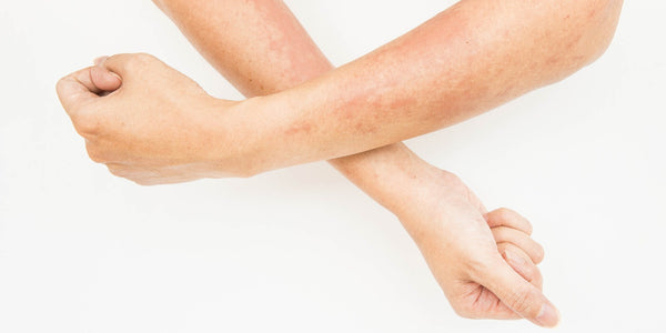 The month of August is Psoriasis awareness month: Can CBD help?