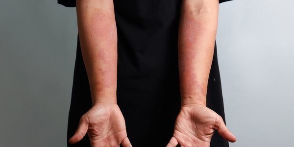 How can CBD help Eczema sufferers?